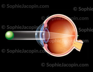 Représentation d'un oeil hypermétrope (oeil trop court), formation de l'image en arrière de la rétine ce qui induit une vision floue de près - © Sophie Jacopin