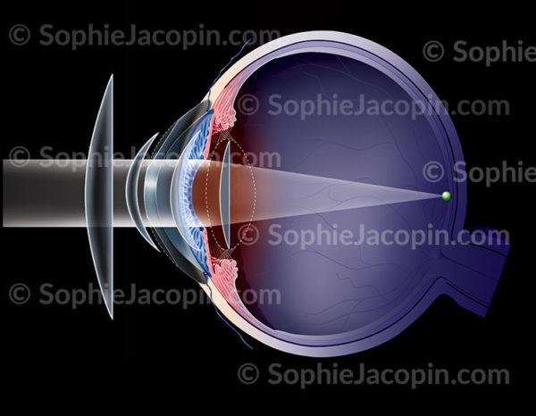 Récapitulatif des différentes corrections possibles sur une oeil hypermétrope : verres de lunette, lentilles externes, chirurgie au laser -© Sophie Jacopin