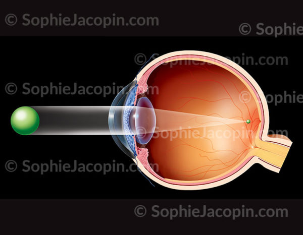 Représentation d'un œil myope (oeil trop long ou cornée trop bombée). L'image se forme en avant de la rétine d'où une vision floue de loin - © Sophie Jacopin