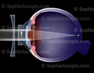 Récapitulatif des différentes corrections possibles sur une oeil myope : verres de lunette,lentilles externes, chirurgie au laser, lentille - © Sophie Jacopin