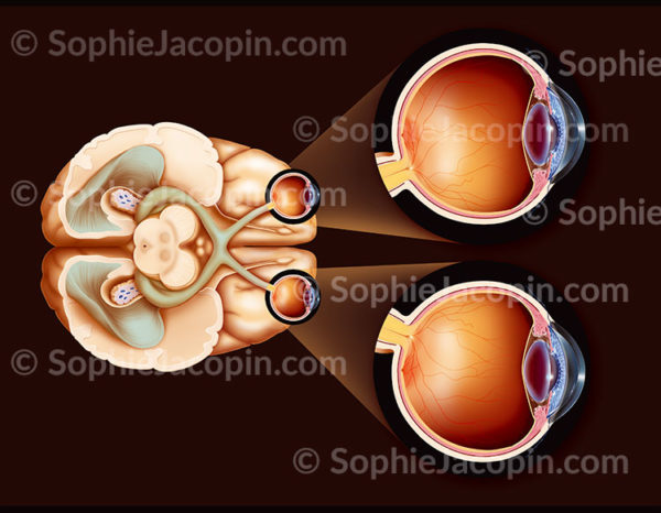 Trajet des voies visuelles depuis l’œil jusqu'aux aires visuelles du cerveau, avec zoom sur l’œil normal en coupe - © sophie jacopin