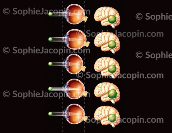 Troubles de la réfraction, comparaison entre un œil normal, un œil myope, hypermétrope, astigmate et presbyte - © sophie jacopin