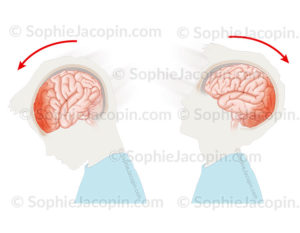 Contusions cérébrales, lésions du cerveau causées par un choc du cerveau contre le crâne, ecchymoses, œdème - © sophie jacopin