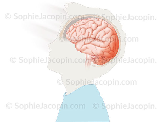 Hématome cérébral chez l’enfant sur la partie postérieure du cerveau suite à un choc à l’arrière de la tête., ecchymose, et des œdèmes - © sophie jacopin