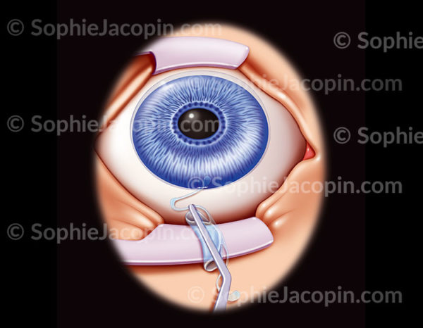 Pose d'un implant intraoculaire dans la chambre antérieure de l’œil, l'implant est plié avant d'être introduit dans la chambre antérieure - © sophie jacopin