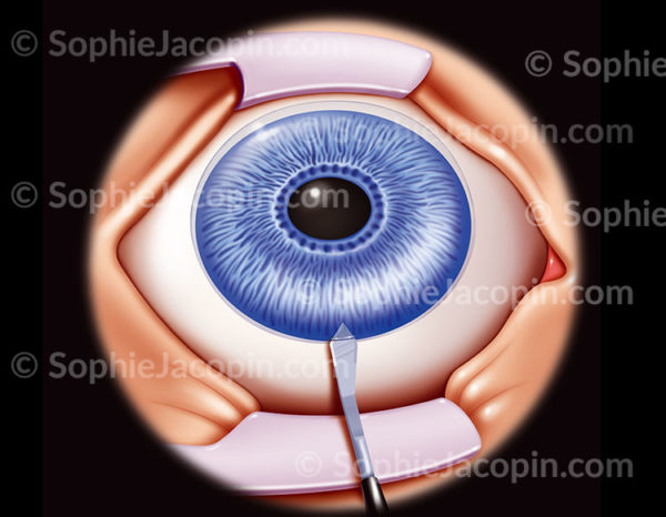 Pose d'un implant intraoculaire dans la chambre antérieur de l’œil, petite incision de 3 à 4 mm effectuée dans la cornée à la limite entre cornée et l'iris - © sophie jacopin