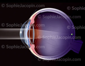 Implants intraoculaires : implant dans la chambre antérieure et postérieure (phake), implant fixé à l'iris, implant cristallinien - © sophie jacopin