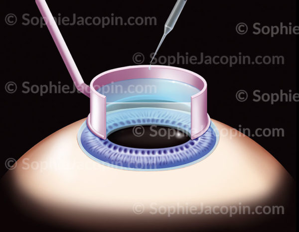Première étape de la PKR, du Lasek et de l’Épi-lasik, chirurgie oculaire, application d’alcool sur la cornée - © sophie jacopin