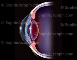 Photokératectomie dans le cas de la correction de la myopie, la partie centrale de la cornée,en pointillés, est enlevée grâce au laser - © sophie jacopin