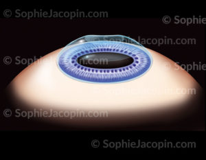 Représentation de l'œil après l'opération de la photokératectomie, opération au laser qui modifie la courbure de la cornée - © sophie jacopin