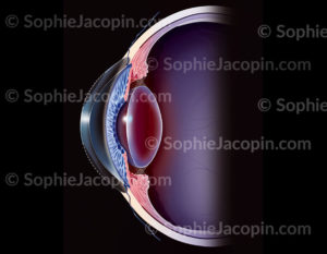Photokératectomie réfractive , correction de l'hypermétropie (partie périphérique de la cornée, en pointillés, enlevée grâce au laser. - © sophie jacopin
