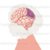 AVC ischémique, artère cérébral obstruée par un thrombus ou une plaque d’athérome - © sophie jacopin