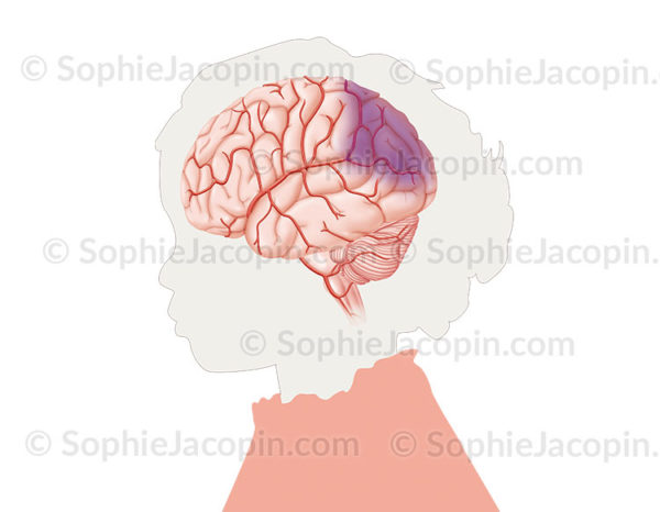 AVC ischémique, artère cérébral obstruée par un thrombus ou une plaque d’athérome - © sophie jacopin