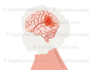 AVC hémorragique, rupture d’une artère au niveau du cerveau.La zone rouge indique la zone du cerveau dans laquelle le sang s’est répandu © sophie jacopin