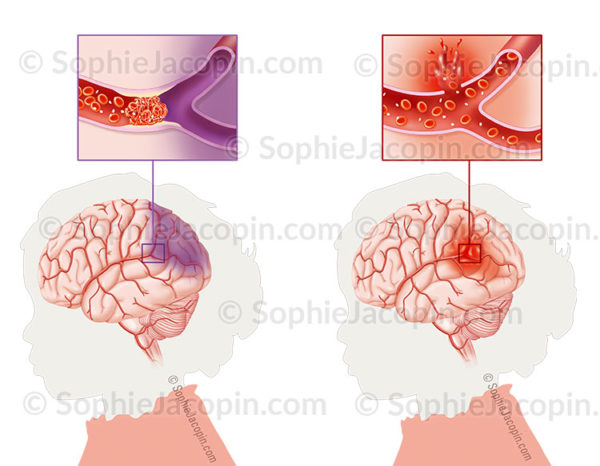 AVC ischémique, artère cérébral obstruée par un thrombus ou une plaque d'athérome, hémorragique, rupture d’une artère cérébrale - © sophie jacopin