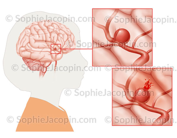 Anévrisme cérébral, dilatation de la paroi d’une artère du cerveau pouvant se rompre - © sophie jacopin