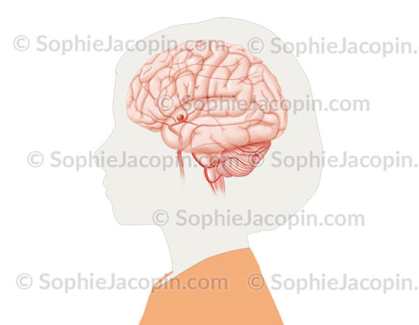 Anévrisme cérébral chez l’enfant, dilatation de la paroi de l'artère cérébrale moyenne visible en transparence dans le cerveau - © sophie jacopin