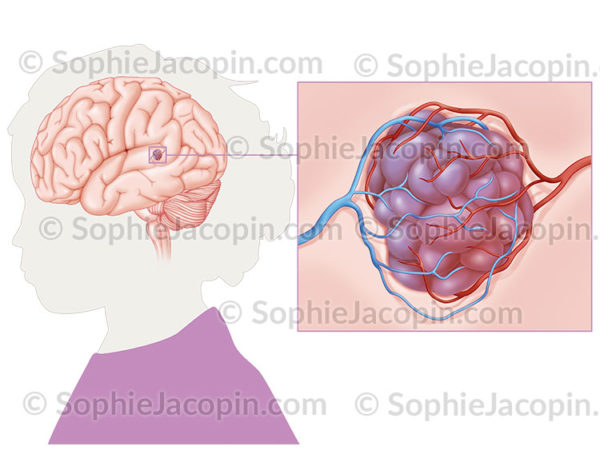 Le cavernome ou angiome caverneux est une malformation vasculaire cérébrale ressemblant à une mûre - © sophie jacopin