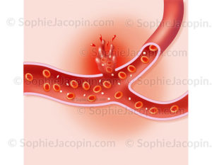 Hémorragie interne, rupture d’une artère laissant échapper le sang en dehors de l’espace vasculaire - © sophie jacopin