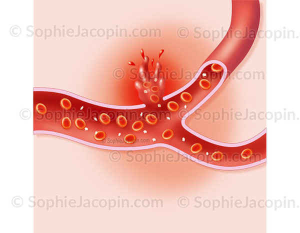 Hémorragie interne, rupture d’une artère laissant échapper le sang en dehors de l’espace vasculaire - © sophie jacopin