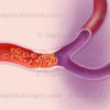 Ischémie, obstruction d’une artère par une plaque d’athérome ou un thrombus - © sophie jacopin