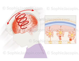 Lésions axonales diffuses suite à un traumatisme (chute, accident, syndrome du bébé secoué) qui endommagent les neurones - © sophie jacopin