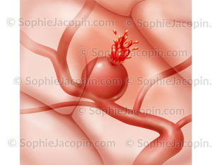 Rupture d’anévrisme cérébral, dilatation de la paroi d’une artère allant jusqu’à sa rupture - © sophie jacopin