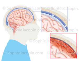 Méninges et méningite, anatomie des méninges et détail au niveau de l’inflammation des couches de l’enveloppe de protection du cerveau - © sophie jacopin