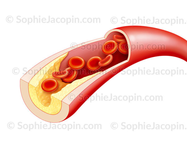 Athérosclérose, plaque d'athérome obstruant la paroi interne des artères de gros calibre due à un dépôts graisseux - © sophie jacopin