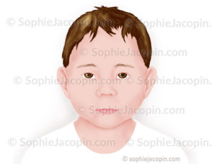 Dysmorphie faciale, signes caractéristiques d’un enfant atteint d’un syndrome d’alcoolisme fœtale en pédiatrie - © sophie jacopin