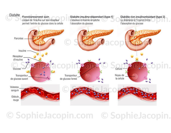 Glycémie et diabètes de type I et II, dysfonctionnement de l'absorption des glucides, taux de glycémie sanguine - © sophie jacopin