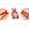 Les maladies coronariennes, plaque d'athérome, angine de poitrine, thrombus, crise cardiaque - © sophie jacopin