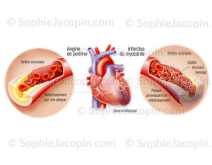 Pathologies coronariennes, plaque d'athérome, angine de poitrine, thrombus, crise cardiaque - © sophie jacopin